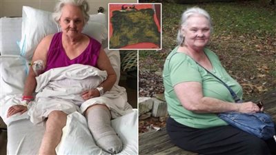 مسنة أمريكية تحصل على 10 ملايين دولار تعويضًا عن «إسفنجة» | صور