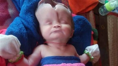 طفلة تواجه الموت بعد ولادتها بانعدام الدماغ (صور)