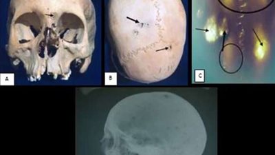 ديلي ميل: العثور على مومياوات لقدماء المصريين مصابة بالسرطان (صور)