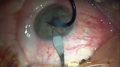 بالفيديو والصور.. لحظة إزالة خطاف سنارة صيد من عين رجل