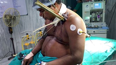 بالصور.. سائق أتوبيس ينجو بأعجوبة بعد طعنه بأعواد الخيزران