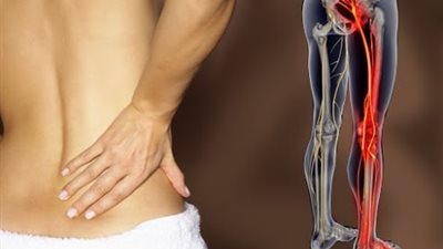 أسباب «عرق النسا» وأعراضه وطرق العلاج