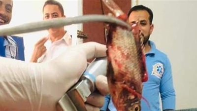 استخراج سمكة «حية» من داخل قصبة هوائية لـ «صياد»  بني سويف