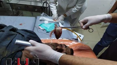 أول فيديو لعملية استخراج سمكة «حية» ابتلعها صياد ببني سويف