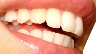 متى يصبح تخلخل الأسنان مشكلة صحية؟.. الأسباب وطرق الوقاية منها