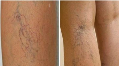 جراح يوضح كيفية إزالة الشعيرات الدموية بالساقين