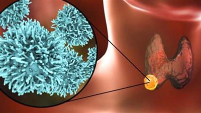 سرطان الغدة الدرقية.. 3 علامات تحذيرية عليك معرفتها