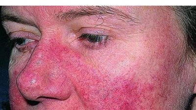 كل ما تريد معرفته عن مرض الذئبة الحمراء.. الأعراض والأسباب والعلاج