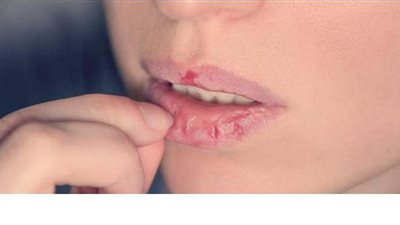 العسل والفازلين كلمة السر للتخلص من تشقق الشفاه خلال الشتاء