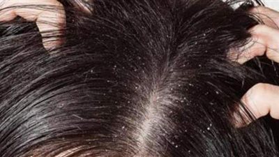 عصير الليمون والعسل للتخلص نهائياً من قشرة الشعر