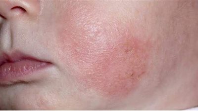 تعرف على مرض الصدفية وأعراضها