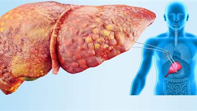 تعرف على أعراض الإصابة بمرض الكبد الدهني وأهم الإرشادات الغذائية