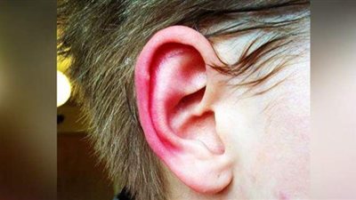 منها التأثير العاطفي.. 3 أسباب لاحمرار الأذن ودفئها في الشتاء