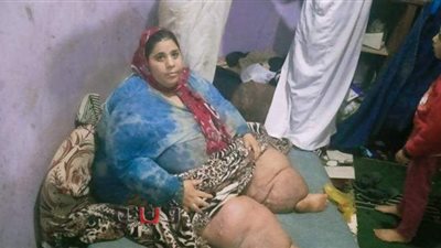 مرض الفيل يصيب عزيزة ووزنها يصل 500 كيلو.. ووالدها: 