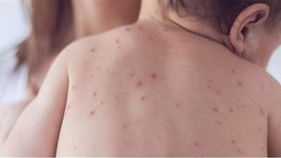 أعراض الحصبة عند الأطفال