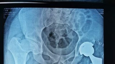 استغرقت 3 ساعات .. استبدال مفصل الفخذ بآخر  صناعي  لمريض بالمنصورة