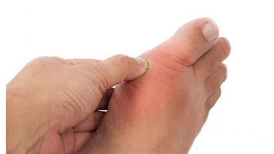 علاج النقرس بالأعشاب