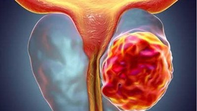 أستاذ أورام: ٣١٠٩ حالات جديدة بسرطان البروستاتا سنويًا في مصر