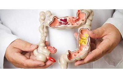 أعراض سرطان الأمعاء.. ​متى يكون المغص علامة على إصابتك بالمرض الخطير