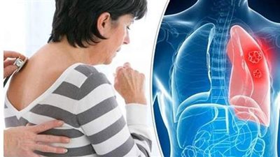 فقدان الوزن السريع.. أعراض سرطان الرئة 