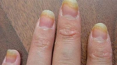 تخلصي من مشكلات فطريات الأظافر بهذه العلاجات