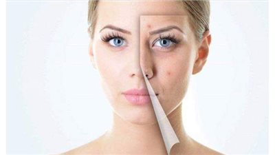 وصفات طبيعية لإزالة حبوب الوجه في يوم واحد