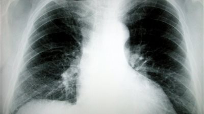 دراسة طبية: سرطان الرئة الأكثر فتكا بين البريطانيات