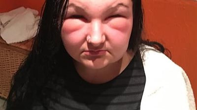 «صبغة شعر» تصيب فتاة بالعمى لمدة يومين (صور)