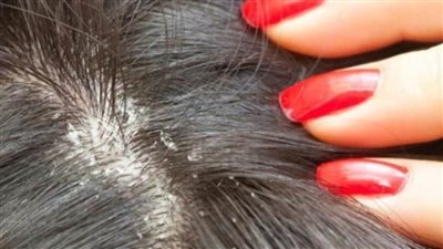 5 نصائح لعلاج القمل عند الأطفال