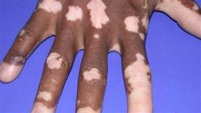 أسباب مرض البهاق