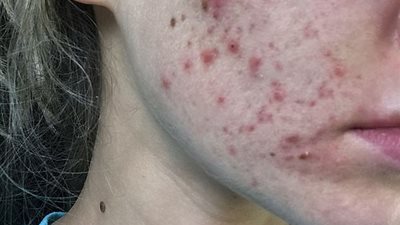 بالصور.. فتاة تكشف عن نتيجة علاج حب الشباب بالليزر