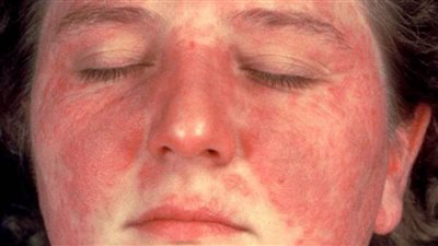 أعراض وأسباب الإصابة بمرض الذئبة الحمراء