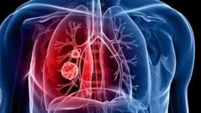 باحثون صينيون يحددون علاجا جديدا محتملا لسرطان الرئة