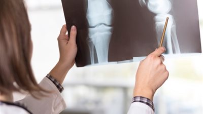 عدم ممارسة الرياضة تصيب بهشاشة العظام