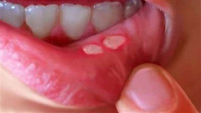 علاج قرحة الفم وأسبابها وطرق تخفيف الألم الناتج عنها