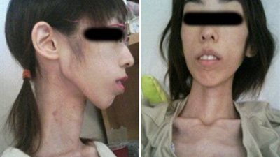 جد يجوع حفيدته حتى بلغ وزنها 17 كجم (صور)