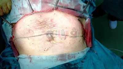 إجراء جراحة لسيدة تعاني من سمنة مفرطة بمستشفى نويبع