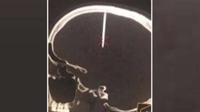 مفاجأة صادمة لرجل يشكو من الصداع