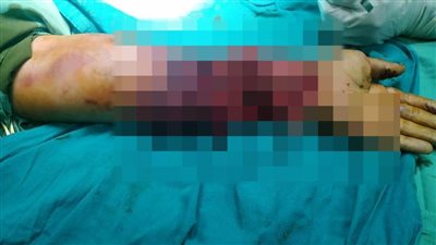 الجراحات الميكروسكوبية بمستشفيات قنا الجامعية تنقذ ذراع سيدة من البتر | صور