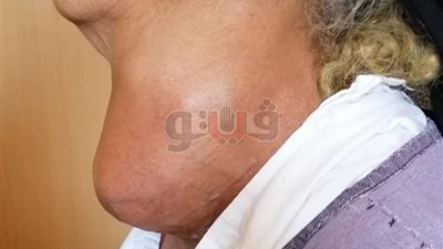 جراحة نادرة لاستئصال تضخم بالغدة الدرقية لمسنة بـ«بني سويف» (صور)