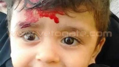 حبس ربة منزل تعدت على طفلتها بـ«ماسورة» وأصابتها بنزيف في المخ