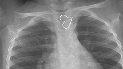 طفلة تبتلع قلادة والدتها (صور)