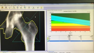 «إلكتريك» تكشف عن أحدث حلولها التشخيصية لهشاشة العظام في مصر