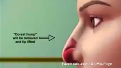 بالفيديو.. شاهد كيف تتم عمليات تجميل الأنف