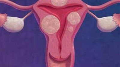 بطانة الرحم المهاجرة | تؤثر على الخصوبة وتسبب تأخر الإنجاب