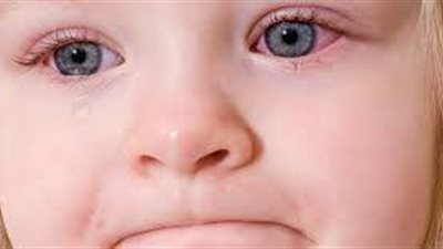 3 علامات تؤكد إصابة طفلك بحساسية العين
