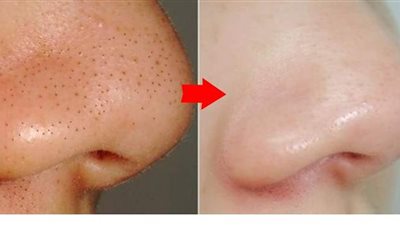 أفضل طرق طبيعية لتخليص البشرات العادية والدهنية من الرؤوس السوداء