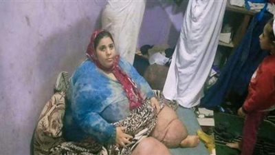 السيسى يوجه بعلاج سيدة مريضة بداء الفيل وإجراء التدخلات العلاجية اللازمة وتوفير الرعاية لأسرتها