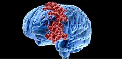 أعراض وأسباب سرطان المخ وطرق العلاج