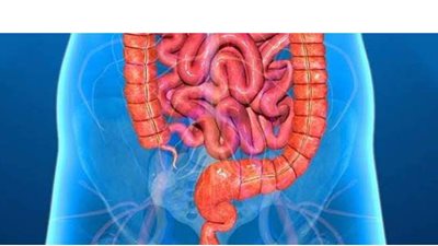 أسباب الإصابة بمرض التهاب القولون التقرحي و أهم الأعراض